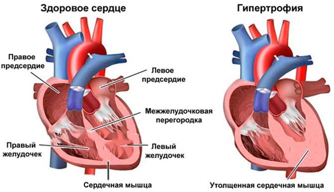 гипертрофия сердца